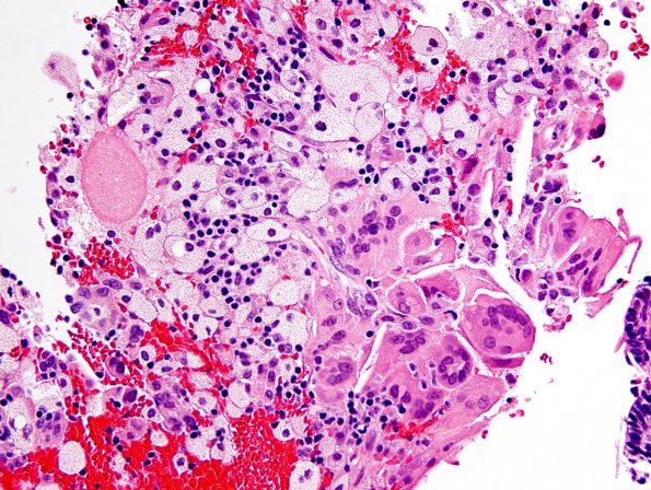 5B7 Craniopharyngioma (Case 5) H&E xanthogranulomatous inflammation 3 b