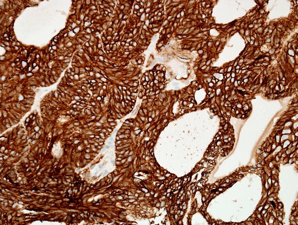 5C1 Craniopharyngioma, adamantinomatous (Case 5) B-catenin 1.jpg