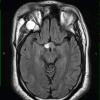 6A1 Craniopharyngioma (Case 6) FLAIR 1 - Copy