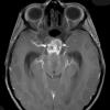 6A2 Craniopharyngioma (Case 6) T1 W 5 - Copy