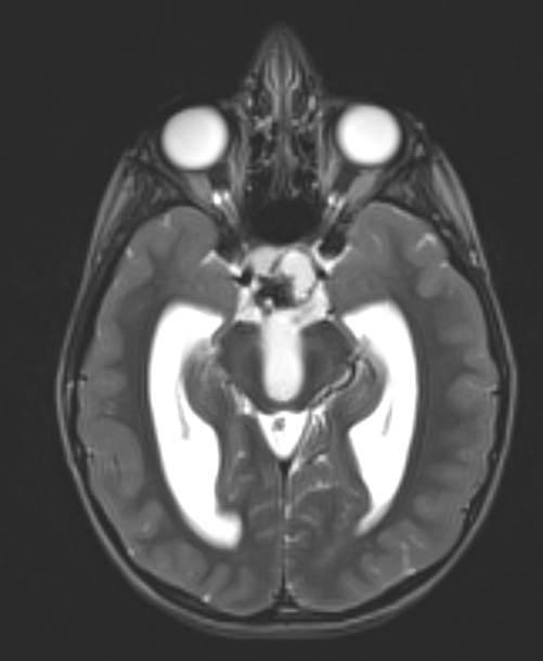 6A3 Craniopharyngioma (Case 6) T2 - Copy