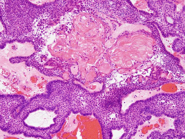 6B1 Craniopharyngioma (Case 6) H&E 8