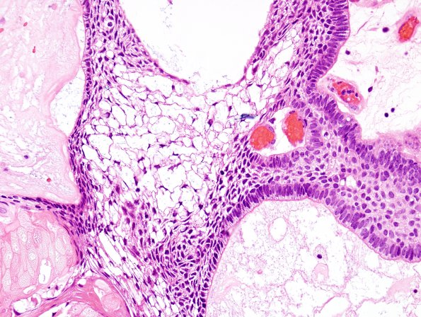 6B2 Craniopharyngioma (Case 6) H&E 3A