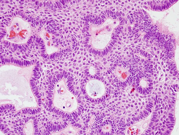 6B3 Craniopharyngioma (Case 6) H&E 5