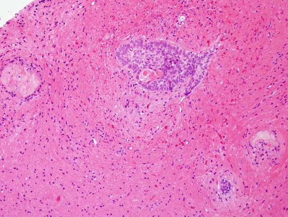 6B5 Craniopharyngioma (Case 6) H&E 1.jpg