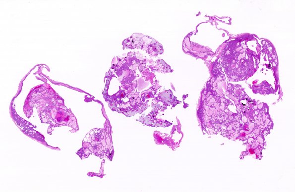 7B1 Craniopharyngioma (Case 7) H&E WM