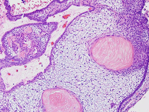 7B3 Craniopharyngioma (Case 7) H&E 2