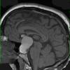 8A Cranio, hemorrhage, reaction (Case 8) T1 1 - Copy