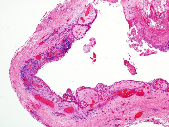 8B1 Cranio, hemorrhage, reaction (Case 8) H&E 1.jpg