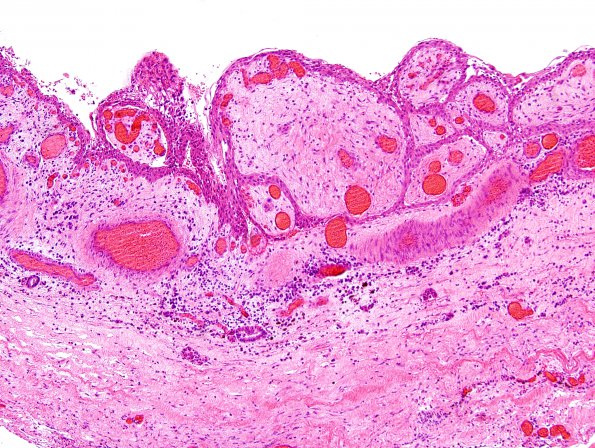 8B2 Cranio, hemorrhage, reaction (Case 8) H&E 2.jpg