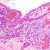 8B3 Cranio, hemorrhage, reaction (Case 8) H&E 9.jpg