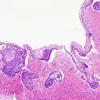 9B1 Craniopharyngioma, within 3rd ventricle (Case 9) 7