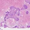 9B2 Craniopharyngioma, within 3rd ventricle (Case 9) 2