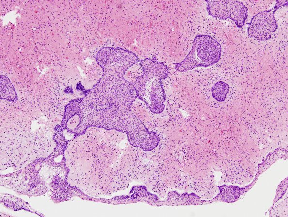 9B2 Craniopharyngioma, within 3rd ventricle (Case 9) 2