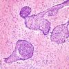 9B3 Craniopharyngioma, within 3rd ventricle (Case 9) 1