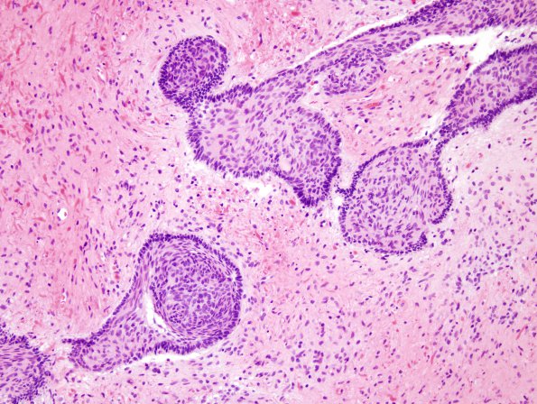 9B3 Craniopharyngioma, within 3rd ventricle (Case 9) 1