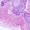 9B4 Craniopharyngioma, within 3rd ventricle (Case 9) 6