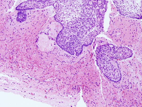 9B4 Craniopharyngioma, within 3rd ventricle (Case 9) 6