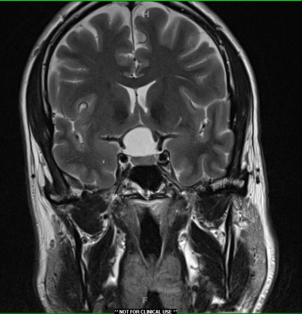 1A2 Craniopharyngioma, papillary (Case 1) T2 Pituitary W 2 - Copy