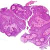 Craniopharyngioma, papillary (Case 1) H&E 4X 7.jpg