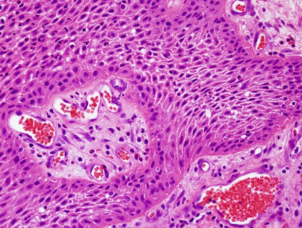 Craniopharyngioma, papillary (Case 1) H&E 2.jpg