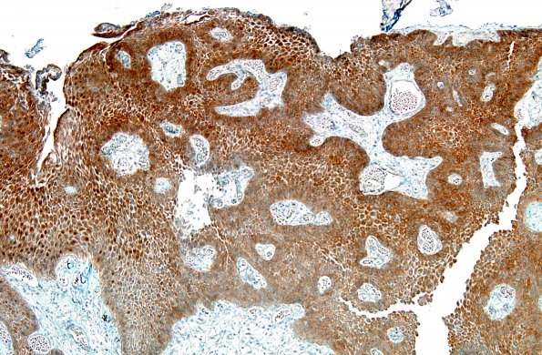 1C1 Craniopharyngioma, papillary (Case 1) BRAF V600E 10X 2