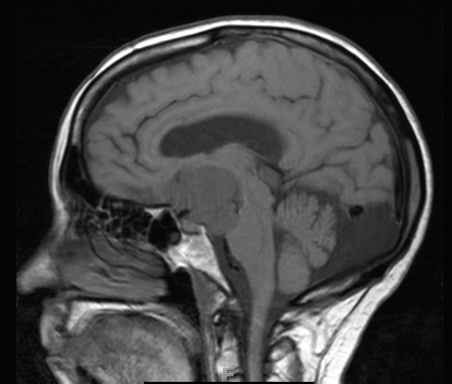 2A4 Craniopharyngioma, Papillary (Case 2) T1 2 - Copy