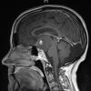 2A5 Craniopharyngioma, Papillary (Case 2) T1 W 4 - Copy