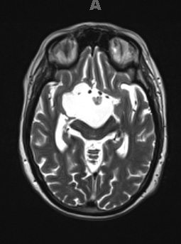 2A6 Craniopharyngioma, Papillary (Case 2) T2 - Copy