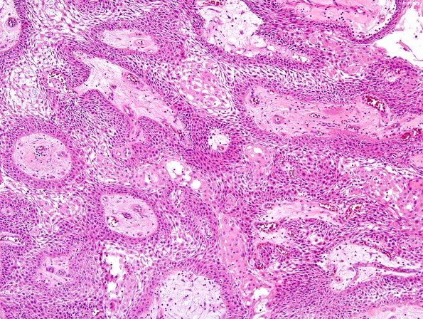 2B1 Craniopharyngioma, papillary (Case 2) H&E 5.jpg