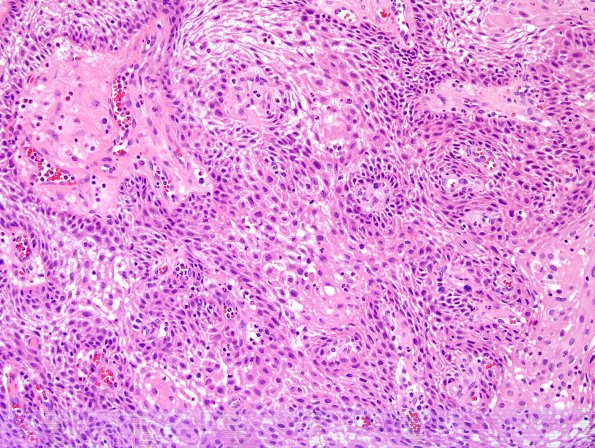 2B2 Craniopharyngioma, papillary (Case 2) H&E 3.jpg