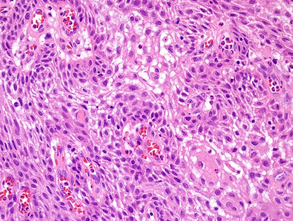 2B3 Craniopharyngioma, papillary (Case 2) H&E 2.jpg