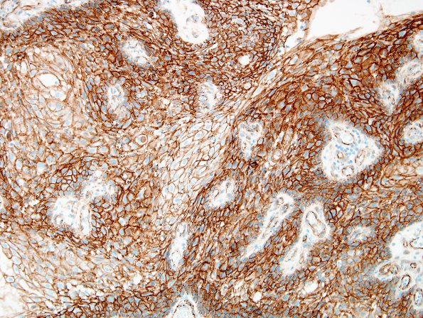 2C1 Cranio, papillary (Case 2) B-catenin 1.jpg