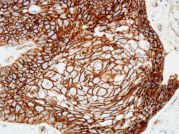 2C3 Craniopharyngioma, papillary (Case 2) B-catenin 8.jpg