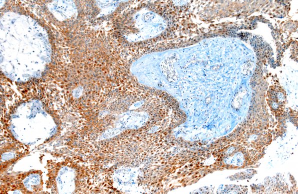 2D2 Craniopharyngioma, Papillary (Case 2) BRAF 10X 1