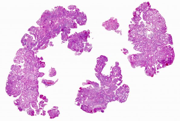 3B1 Craniopharyngioma, papillary (Case 3) H&E WM