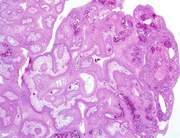 3B2 Craniopharyngioma, papillary (Case 3) H&E 3.jpg