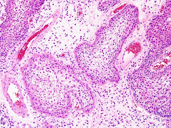 3B4 Craniopharyngioma, papillary (Case 3) H&E 11.jpg