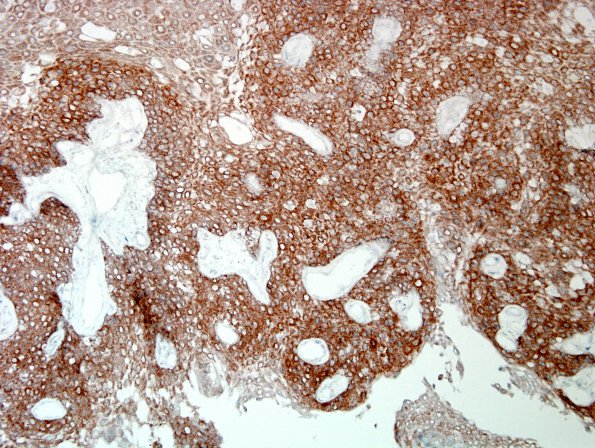 3C2 Craniopharyngioma, papillary (Case 3) BRAF 3.jpg