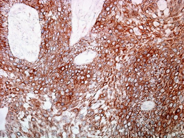 3C3 Craniopharyngioma, papillary (Case 3) BRAF 1.jpg