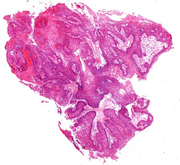 4A1 Craniopharyngioma, papillary (Case 4) H&E 16.jpg