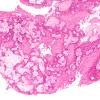 4A4 Craniopharyngioma, papillary (Case 4) H&E 15