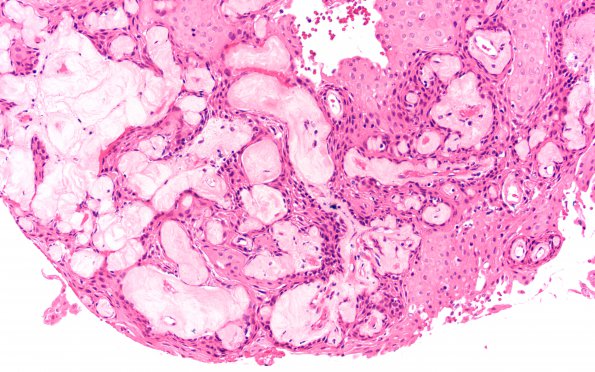 4A5 Craniopharyngioma, papillary (Case 4) H&E 15