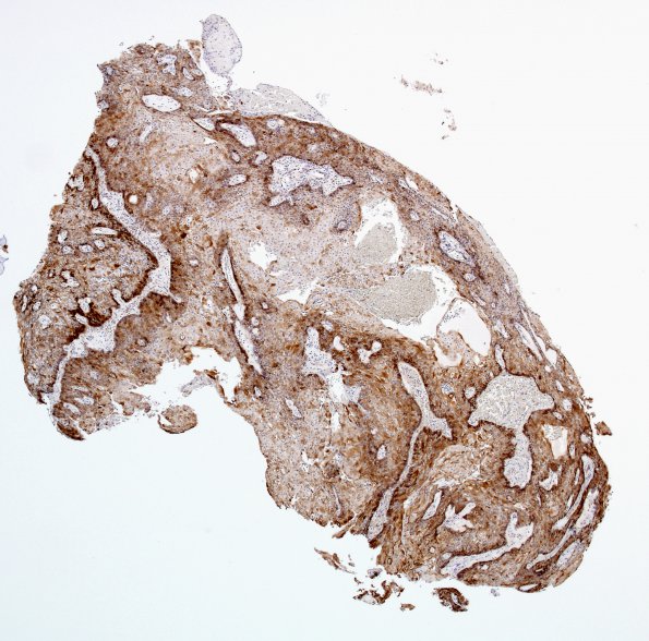 4B1 Craniopharyngioma, papillary (Case 4) EMA 8.jpg