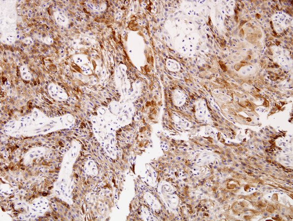 4B2 Craniopharyngioma, papillary (Case 4) EMA 3.jpg