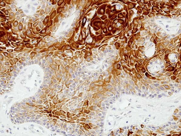 4C3 Craniopharyngioma, papillary (Case 4) CK 2.jpg