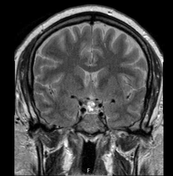 5A1 Pap Cranio (Case 5) T2W - Copy