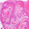 5B2 Craniopharyngioma, Papillary (Case 5) H&E 1