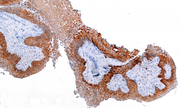 5C1 Craniopharyngioma, Papillary (Case 5) BRAF V600E 1