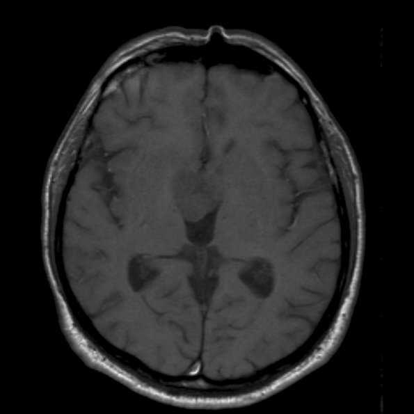 6A1 Craniopharyngioma, Papillary (Case 6) T1 - Copy